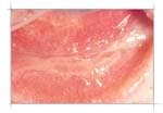 Symblepharon โ conjunctival adhesion