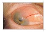 Symblepharon โ amniotic membrane repair