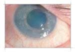 Symblepharon โ surgical lysis