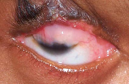 Symblepharon โ adhesion between eyelid and globe conjunctiva