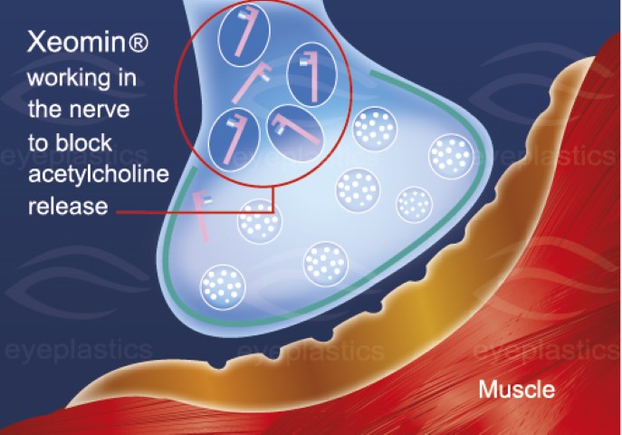 Xeomin โ naked toxin, no accessory proteins