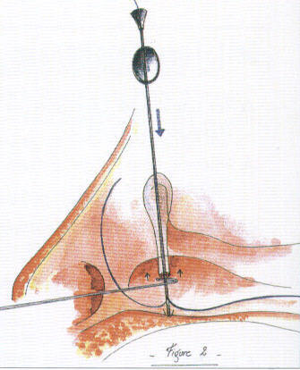 Ritleng mono-canalicular stent