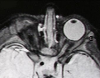 MRI orbital MRI anophthalmosis